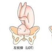 l和p哪个是左,胎儿lop位是什么意思