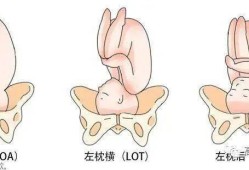 l和p哪个是左,胎儿lop位是什么意思