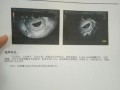 十一周的胎儿有多大（孕10周和孕11周胎心都是180危险吗?应该怎么办，其他的都正常）