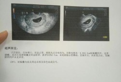 十一周的胎儿有多大（孕10周和孕11周胎心都是180危险吗?应该怎么办，其他的都正常）