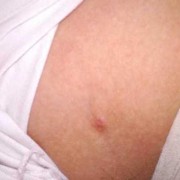 怀孕期间长的副乳图片（怀孕期间长的副乳图片）