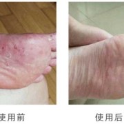 孕妇的脚气怎么治？可以抹什么脚气膏,孕期如何治疗脚气脚臭