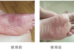 孕妇的脚气怎么治？可以抹什么脚气膏,孕期如何治疗脚气脚臭