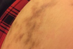 孕期肚皮长斑（孕期肚皮长斑点怎么办）