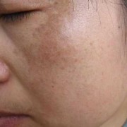 孕期防止长斑（为什么脸上有斑要防晒）