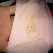 孕期乳头黑（孕妇乳头变黑正常吗）