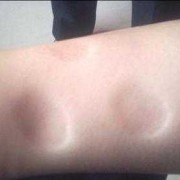 孕妇下肢浮肿的原因，孕期小腿浮肿怎么办,孕期脸浮肿是什么原因引起的