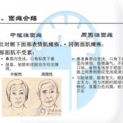 胎儿面瘫（面瘫对怀孕有影响吗）