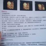 23周照四维，检查宝宝左侧脉络丛囊肿对宝宝有影响吗,双侧脉络丛囊肿胎儿能要吗