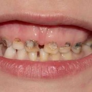 孕期牙齿变黑了怎么办（生完孩子后牙齿有些发黑）