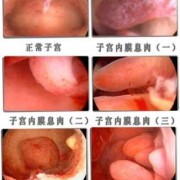 宫颈息肉对胎儿影响（宫颈息肉对胎儿影响大吗）