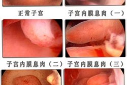 宫颈息肉对胎儿影响（宫颈息肉对胎儿影响大吗）