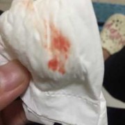 孕期出血是怎么回事,孕期有血是怎么回事