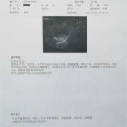 孕期宫内积液（孕期出血宫腔有激液怎么办）