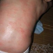 孕妇皮肤长的像痱子粒粒一样还发痒是怎么了,孕期痱子和湿疹图片