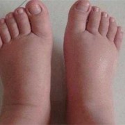 孕期没有水肿（孕期没有水肿）