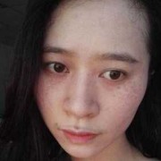 孕期蝴蝶斑（孕期蝴蝶斑产后会消失吗）