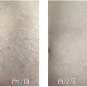 孕期无妊娠纹（怎么才能没有妊娠纹）