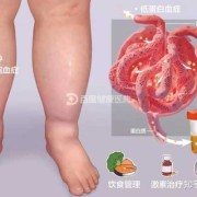 孕期肾病（孕期肾病综合征的临床表现）