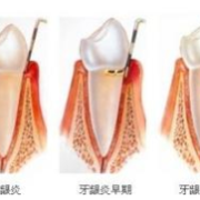 牙周炎会影响胎儿吗（牙周炎会影响胎儿吗）