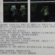 冷热双泡什么意思,胎儿双泡征是什么原因