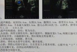 冷热双泡什么意思,胎儿双泡征是什么原因