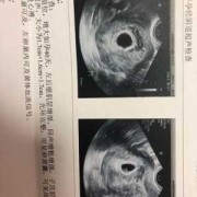 孕期孕囊大小（怀孕40天孕囊大小，它的标准是多少）
