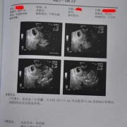 怀孕10周胎儿成型了吗（怀孕10周孕囊胎芽大小是多少，可以介绍下的吗）