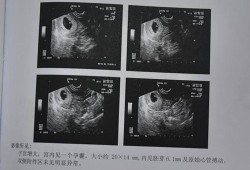 怀孕10周胎儿成型了吗（怀孕10周孕囊胎芽大小是多少，可以介绍下的吗）