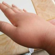 孕期右手肿（孕妇手肿是什么原因）