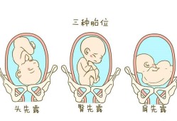 左骶横位胎儿图片（左骶横位胎儿图片）