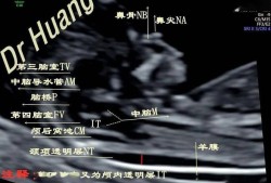 胎儿四肢部分切面可见什么意思,胎儿四肢短小的原因