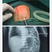 灿可以加什么偏旁,胎儿左侧隔疝要引产吗