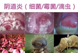 孕期阴部痒怎么办,孕期下体痒怎么办有豆腐渣