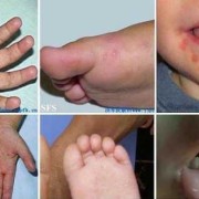 胎儿会感染手足口吗（宝宝得了手口足病持续发热怎么办）