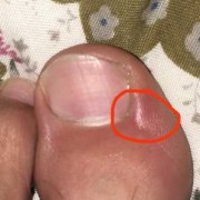 孕期脚红肿（大母脚趾红肿该怎么除理）