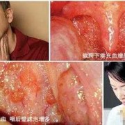 孕期咽喉炎咳嗽厉害怎么办,孕妇咽炎对胎儿有影响吗