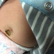 孕期肚脐炎（孕期肚脐炎对宝宝有影响吗）