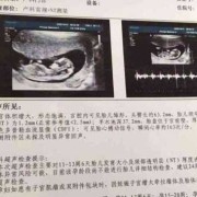 刚出生的婴儿怎么辨别男孩女孩,孕期男孩女孩的区别nt单怎么看