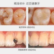 孕期补牙（怀孕能补牙吗）