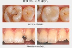 孕期补牙（怀孕能补牙吗）