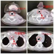 胎儿食道（胎儿食道）