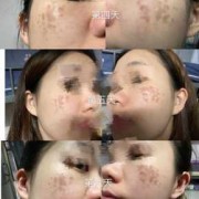 孕妇可以激光祛斑吗,激光对胎儿有影响吗?