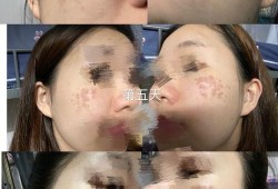 孕妇可以激光祛斑吗,激光对胎儿有影响吗?