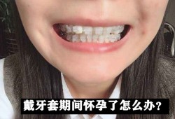 怀孕期间能带牙套吗（怀孕期间能带牙套吗）