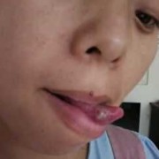 孕期舌头疼怎么办（孕期舌头疼怎么办快速缓解）