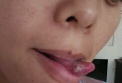 孕期舌头疼怎么办（孕期舌头疼怎么办快速缓解）