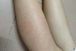 怀孕期腿痒是男孩（怀孕期腿痒是男孩）