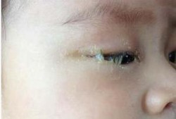 五个月胎儿（5个月宝宝眼睛眼屎多）