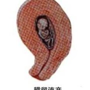 胎儿稽留（胎儿稽留是什么意思）